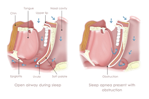 Obstructive Sleep Apnea